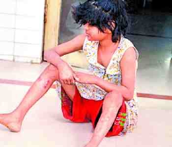 Teenager mentally disabled