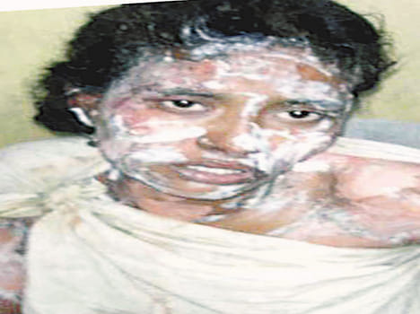 Teenage kerosene oil Put the girl on fire