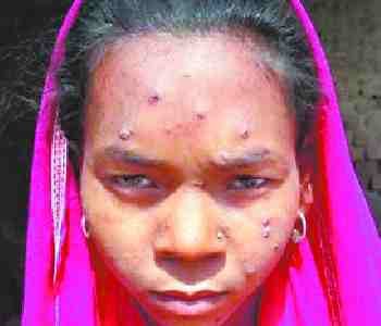 22 children in grip of measles