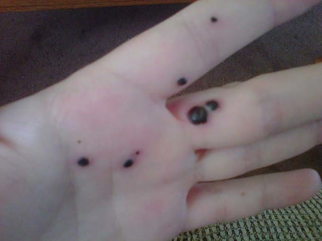 Husband Noticed Mysterious Black Spots On Wife's Hand, What Happened Next Is Simply Haunting!
