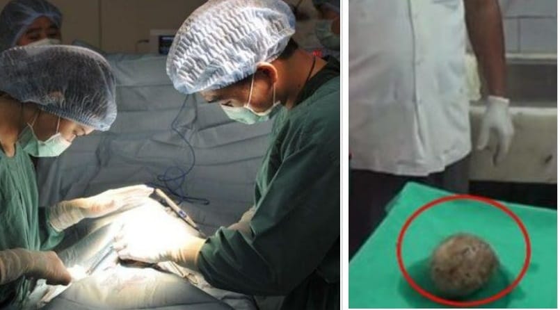 India's single largest bladder stone weighing 1.4 kg removed, says doctor