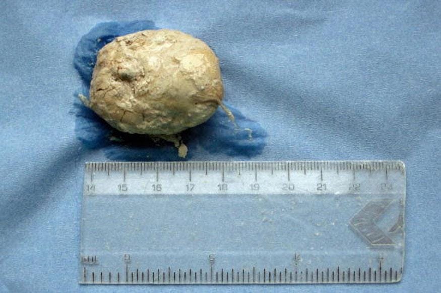 India's single largest bladder stone weighing 1.4 kg removed, says doctor