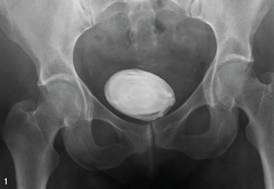 India's single largest bladder stone weighing 1.4 kg removed, says doctor
