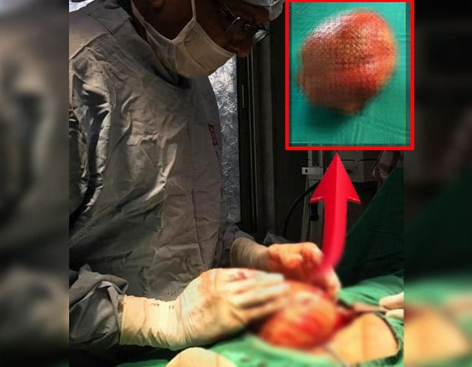 India's single largest bladder stone weighing 1.4 kg removed, says doctor