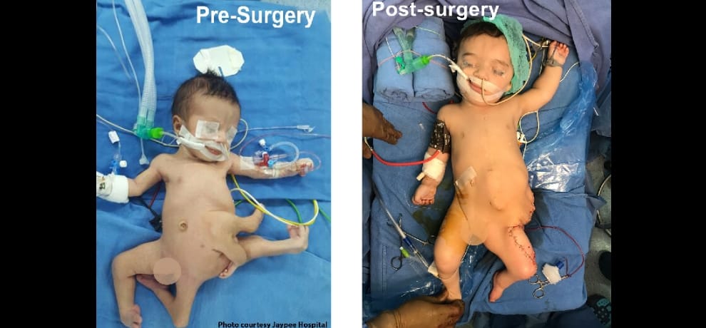 iraq baby with 8 limbs get new life in noida hospital