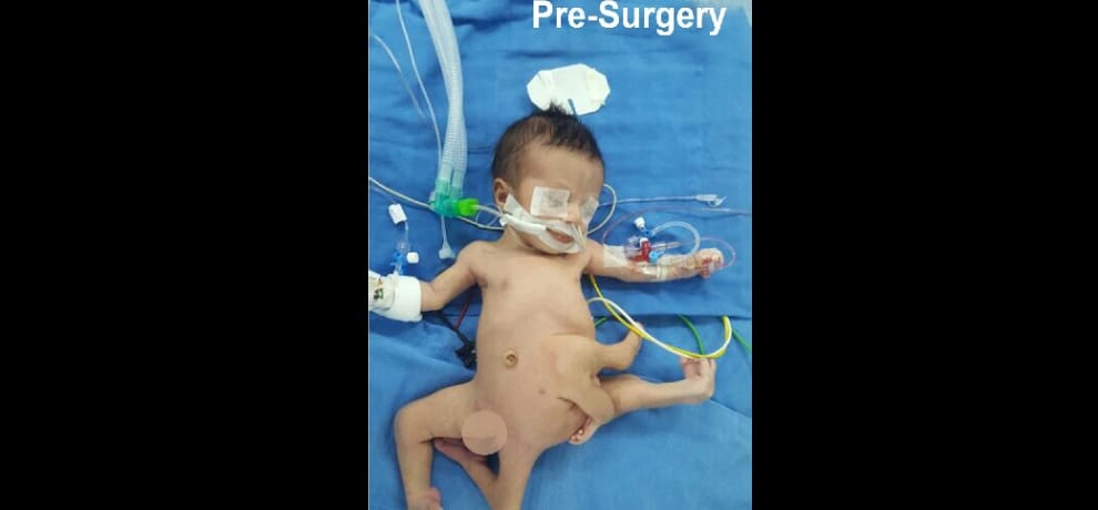 iraq baby with 8 limbs get new life in noida hospital