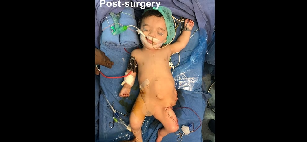 iraq baby with 8 limbs get new life in noida hospital