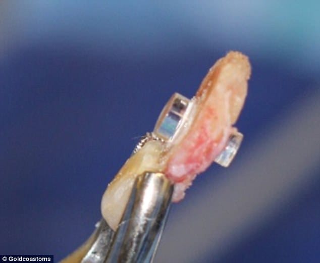 blind man loosed his vision after having his TOOTH inserted into his eye  