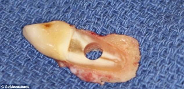 blind man loosed his vision after having his TOOTH inserted into his eye  