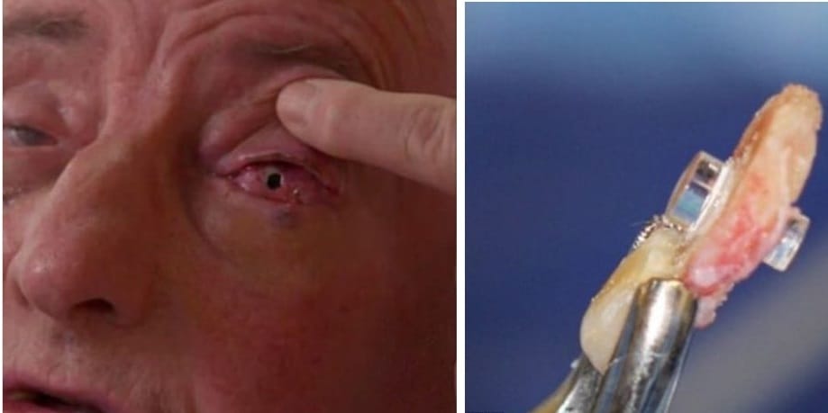 blind man loosed his vision after having his TOOTH inserted into his eye  