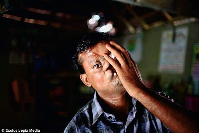 Fisherman whose face was destroyed by a TIGER, he is desperate for plastic surgery