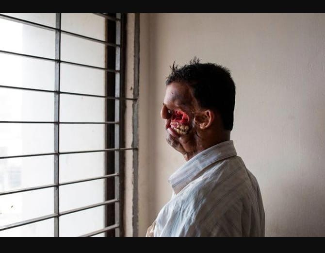 Fisherman whose face was destroyed by a TIGER, he is desperate for plastic surgery