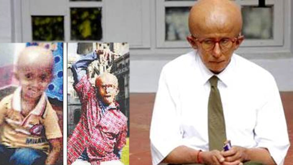 aditya suffering projoriya disease  