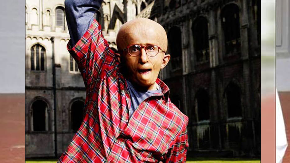aditya suffering projoriya disease  