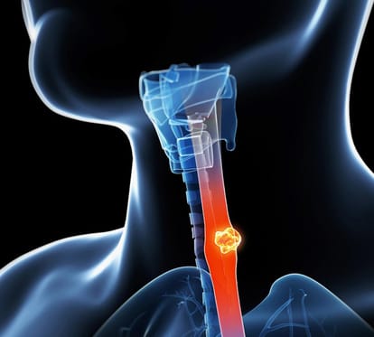 drinking hot beverages can cause cancer