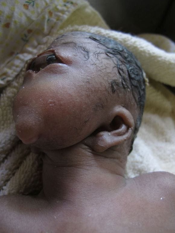 Mother Left Heartbroken After Giving Birth To A Cyclops Baby 