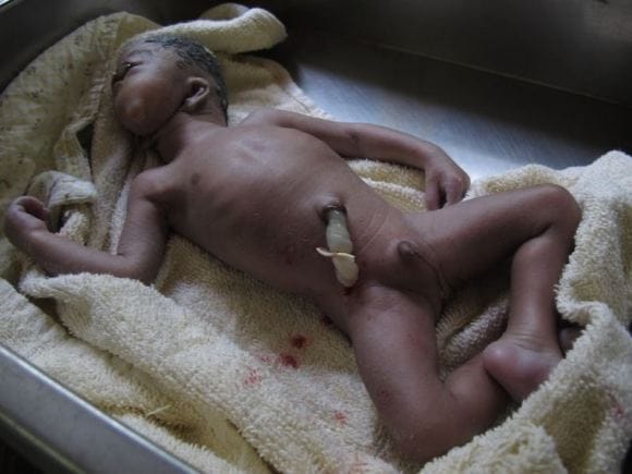 Mother Left Heartbroken After Giving Birth To A Cyclops Baby 