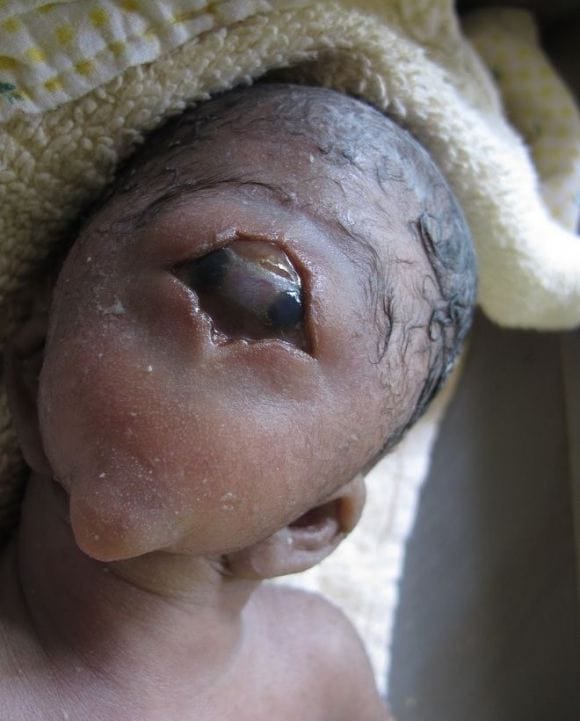Mother Left Heartbroken After Giving Birth To A Cyclops Baby 