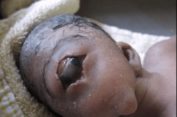Mother Left Heartbroken After Giving Birth To A Cyclops Baby 
