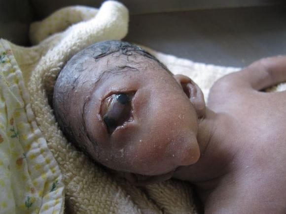 Mother Left Heartbroken After Giving Birth To A Cyclops Baby 
