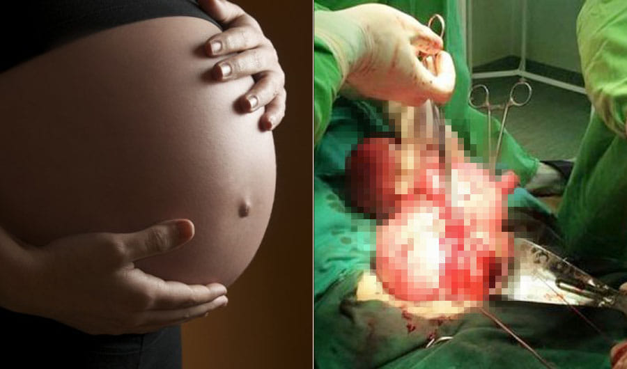  Twin Found Inside girl’s Brain Tormenting Her For 26 Years!