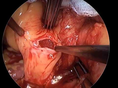  Twin Found Inside girl’s Brain Tormenting Her For 26 Years!