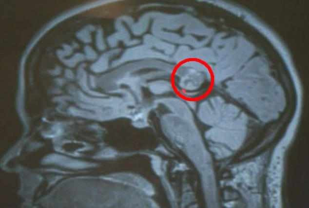  Twin Found Inside girl’s Brain Tormenting Her For 26 Years!