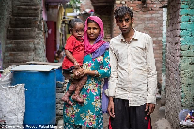 Two-year-old girl suffers from a rare skin condition