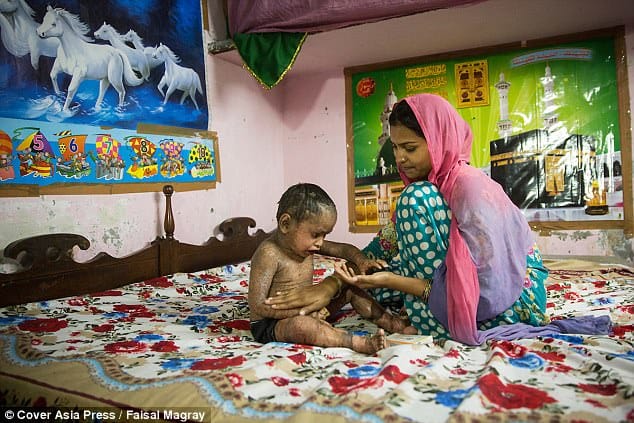 Two-year-old girl suffers from a rare skin condition