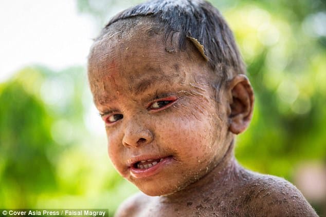 Two-year-old girl suffers from a rare skin condition
