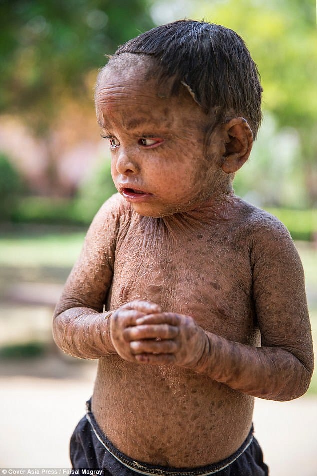 Two-year-old girl suffers from a rare skin condition