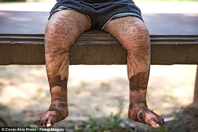 Two-year-old girl suffers from a rare skin condition