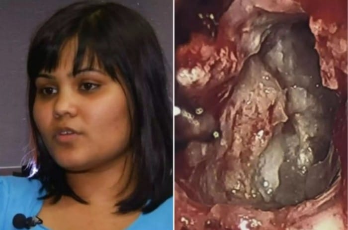  Twin Found Inside girl’s Brain Tormenting Her For 26 Years!