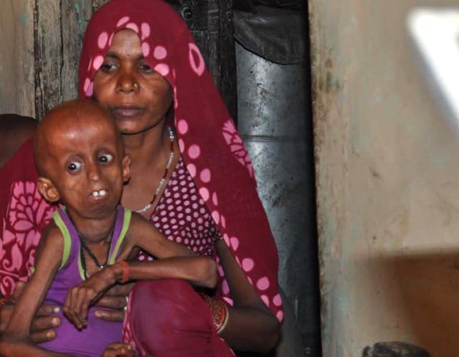 up boy is suffering from progeria