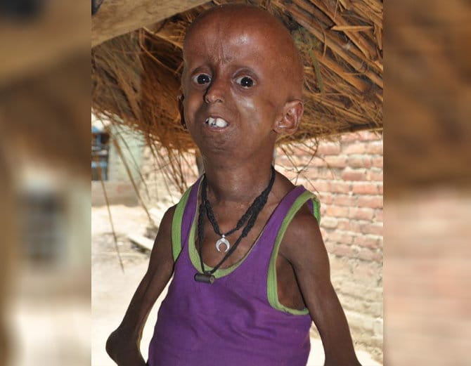 up boy is suffering from progeria