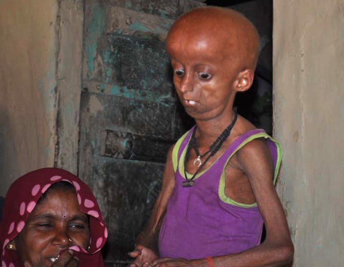 up boy is suffering from progeria