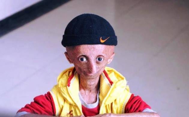 up boy is suffering from progeria