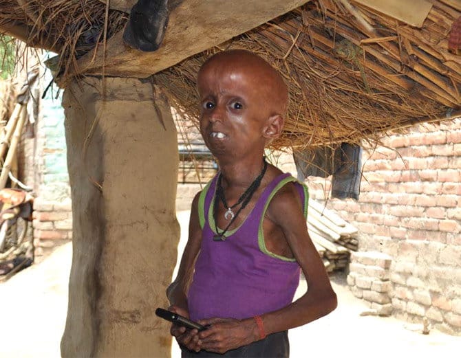 up boy is suffering from progeria