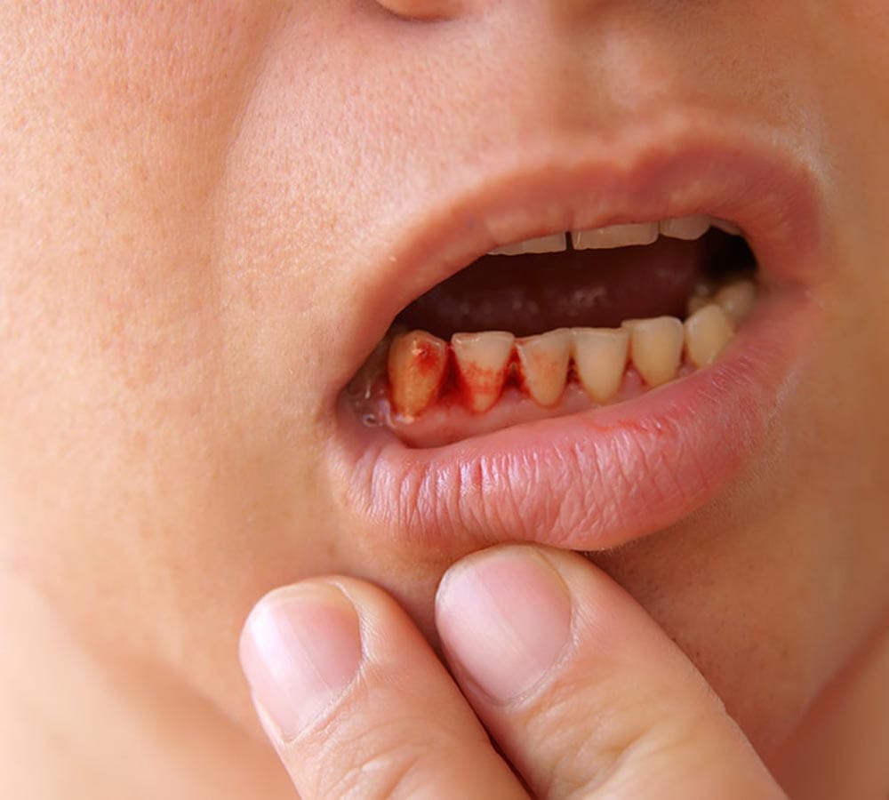 this is what happens when you do not clean your tongue