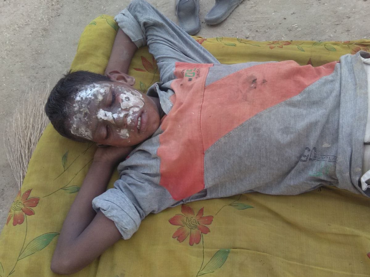 Three kids scorched with firecrackers