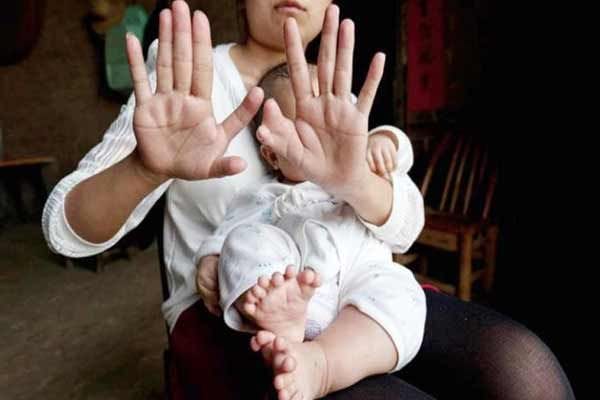 Chinese baby born with 16 toes