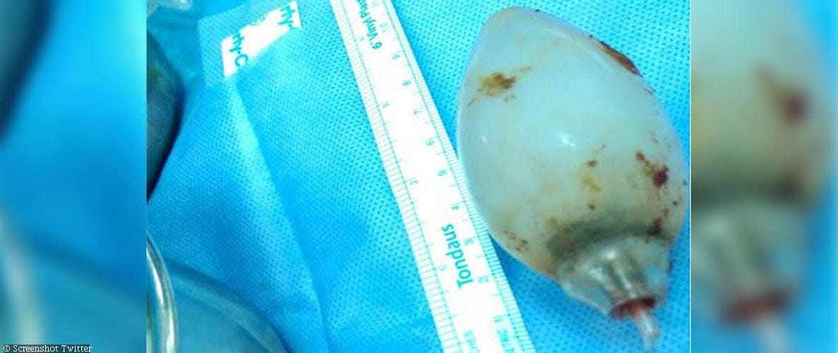 Saudi doctors find bulb inside a guy’s stomach 
