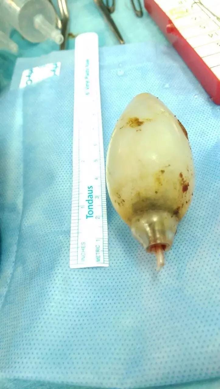 Saudi doctors find bulb inside a guy’s stomach 
