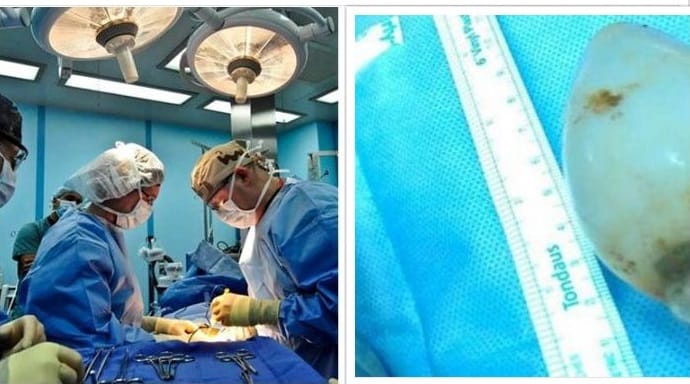 Saudi doctors find bulb inside a guy’s stomach 