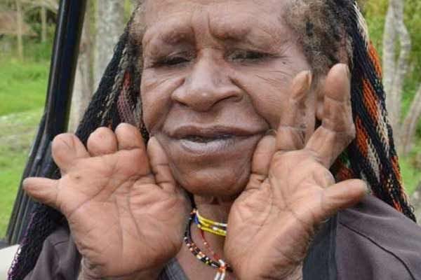 indonesian tradition where women cut off a finger when a loved one dies