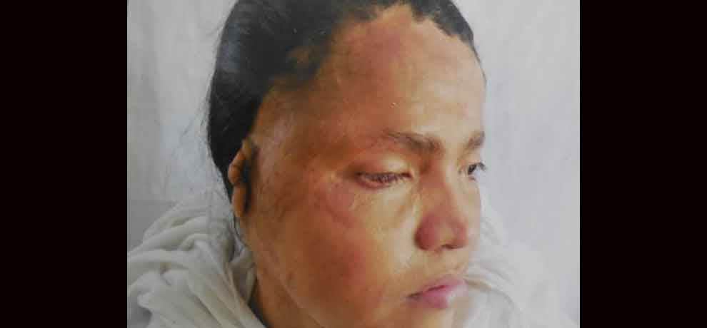 Acid attack survivor rejected by beauty parlors but married to sweetheart