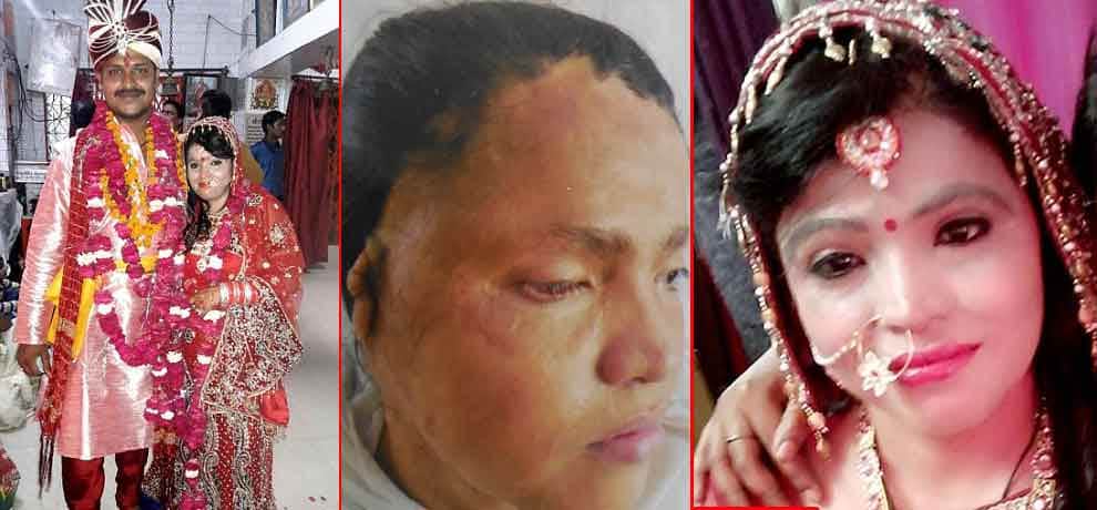Acid attack survivor rejected by beauty parlors but married to sweetheart