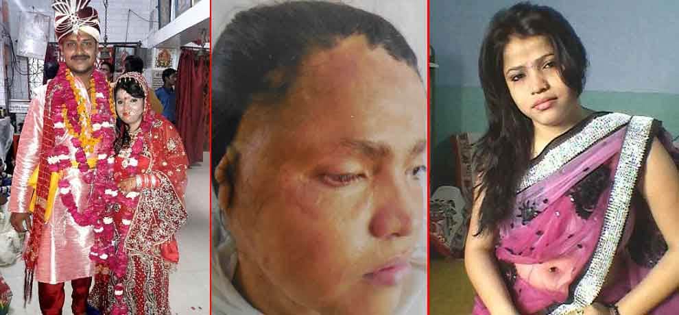 Acid attack survivor rejected by beauty parlors but married to sweetheart