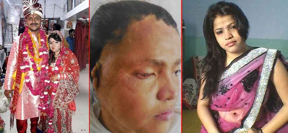 Acid attack survivor rejected by beauty parlors but married to sweetheart