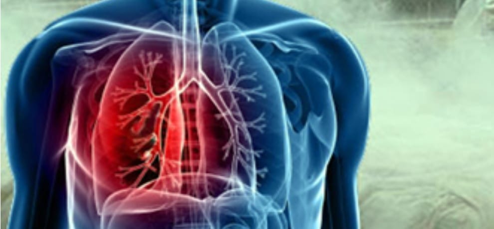 Four new cases of lung disease silicosis in himachal